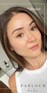 Cheek blush tattoo day 7 — healed result