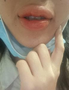 Close-up of swollen lips on day one of lipstick tattoo recovery