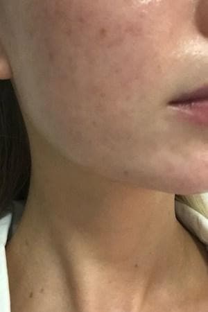 Gracie's skin after one week — calmer, more hydrated and less reactive