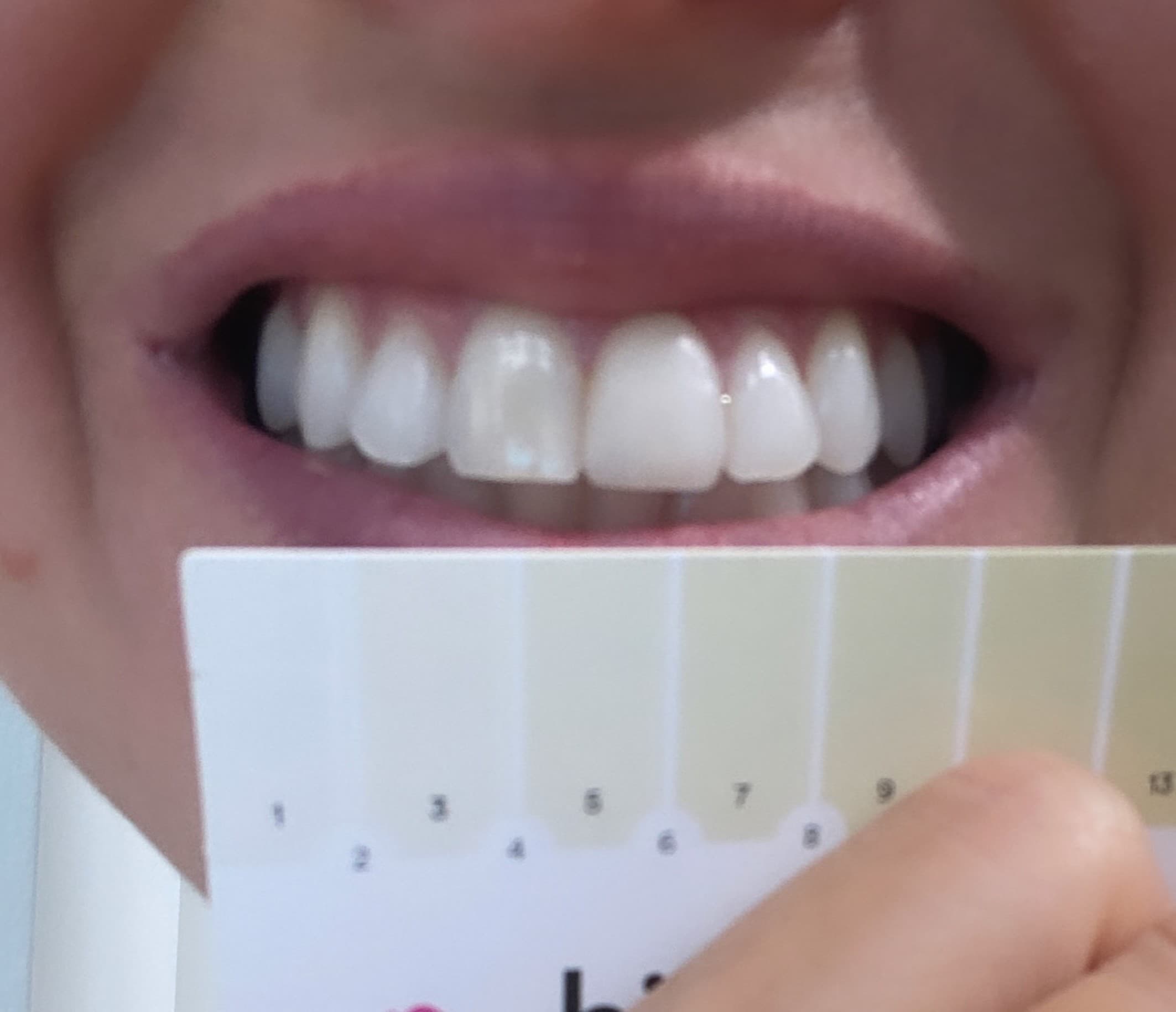 Teeth after HiSmile whitening treatment — visibly whiter with colour guide