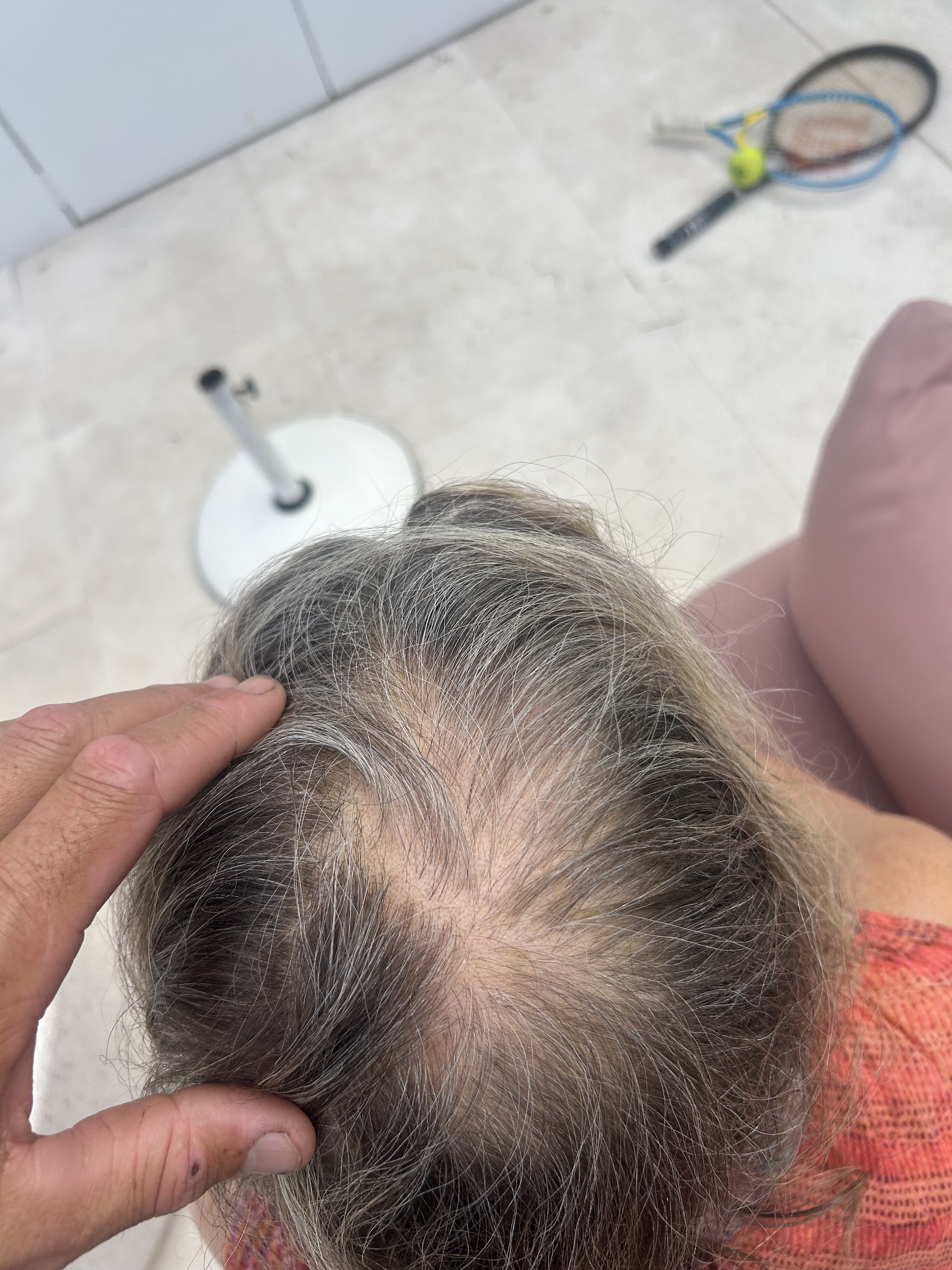 Close-up of the top of Colette's head showing thinning hair and bald patches from chemotherapy